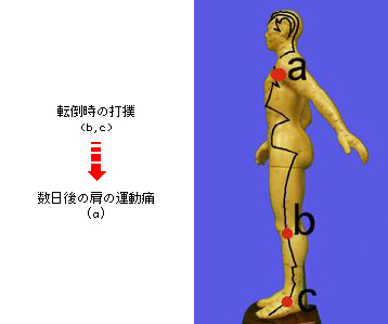 図1-13　下腿外側打撲後の胆経上に出現した異常