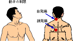 図1-14　経絡の動きと制限の痛みの部位